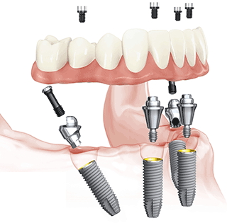 All-on-4® implanttihoidon teemapäivät Kuopiossa 24.5. ja Jyväskylässä 26.5.